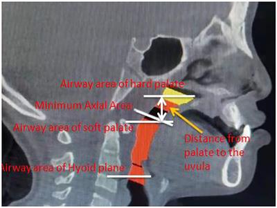 The study on the morphological changes of oropharynx in patients with complete unilateral cleft lip and palate after palatopharyngeal closure